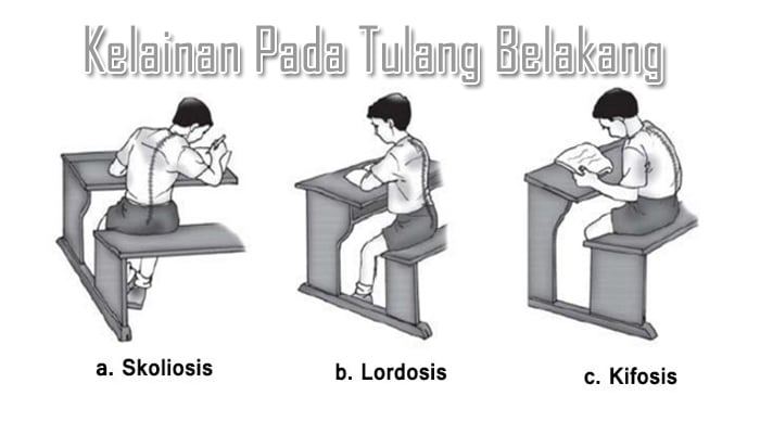 Detail Gambar Skoliosis Lordosis Dan Kifosis Nomer 14