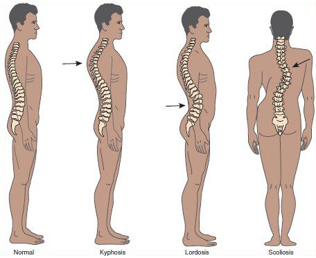 Detail Gambar Skoliosis Lordosis Dan Kifosis Nomer 15