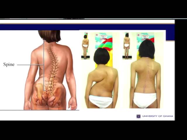 Detail Gambar Skoliosis Lordosis Dan Kifosis Nomer 17