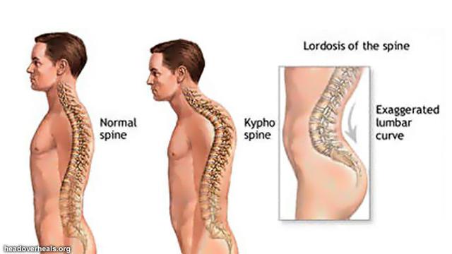 Detail Gambar Skoliosis Lordosis Dan Kifosis Nomer 21