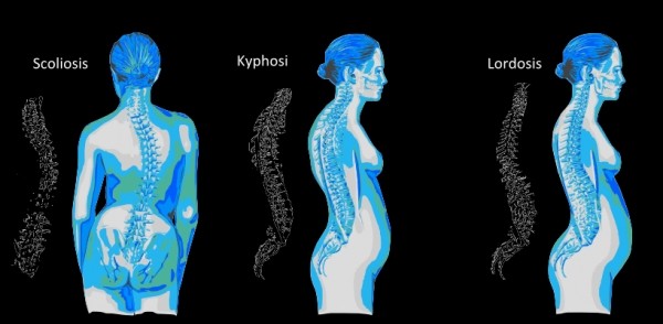 Detail Gambar Skoliosis Lordosis Dan Kifosis Nomer 22