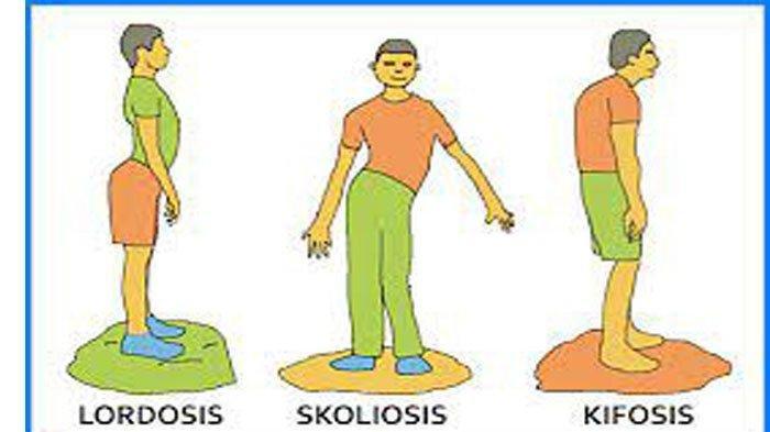 Detail Gambar Skoliosis Lordosis Dan Kifosis Nomer 31