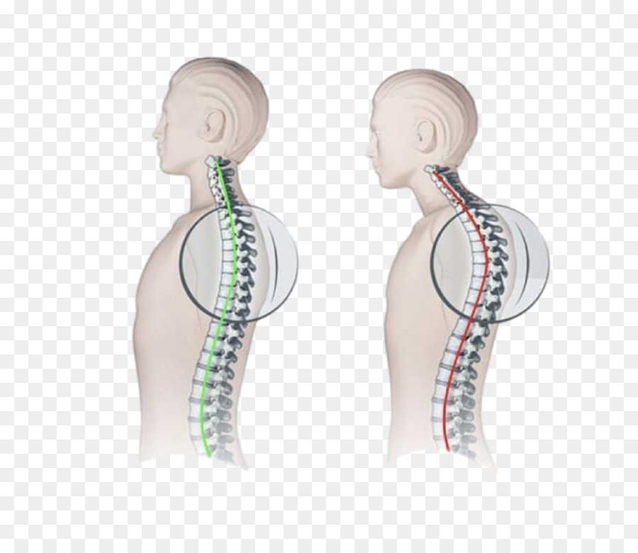 Detail Gambar Skoliosis Lordosis Dan Kifosis Nomer 40