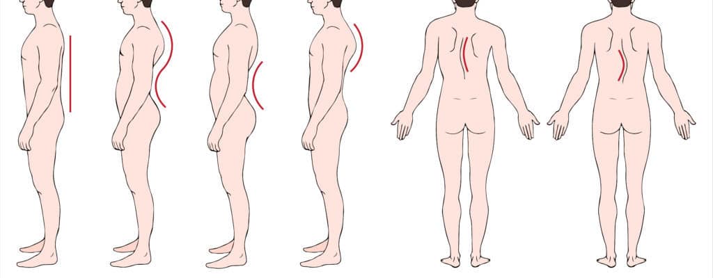 Detail Gambar Skoliosis Lordosis Dan Kifosis Nomer 41