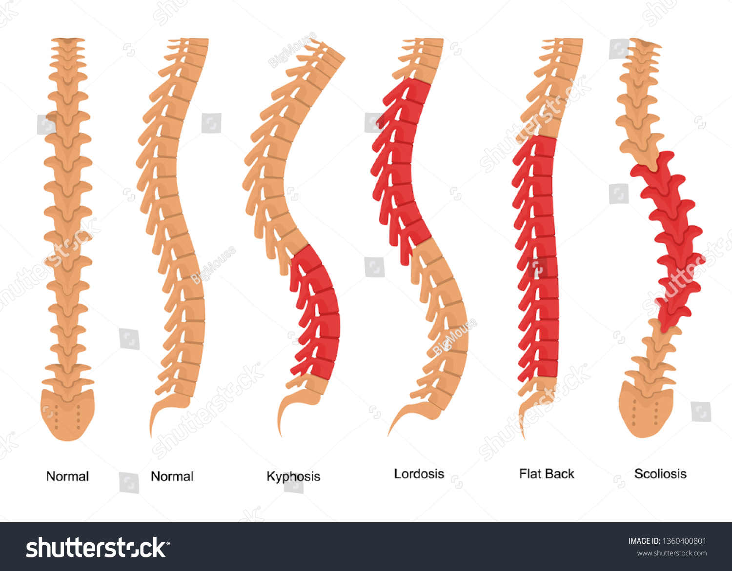 Detail Gambar Skoliosis Lordosis Dan Kifosis Nomer 45