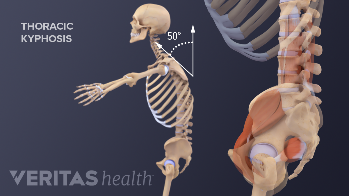 Detail Gambar Skoliosis Lordosis Dan Kifosis Nomer 53