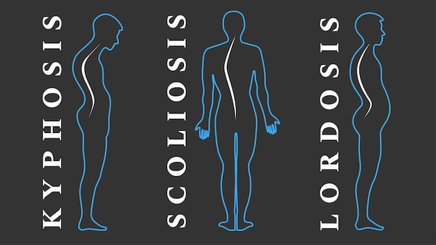 Detail Gambar Skoliosis Lordosis Dan Kifosis Nomer 54