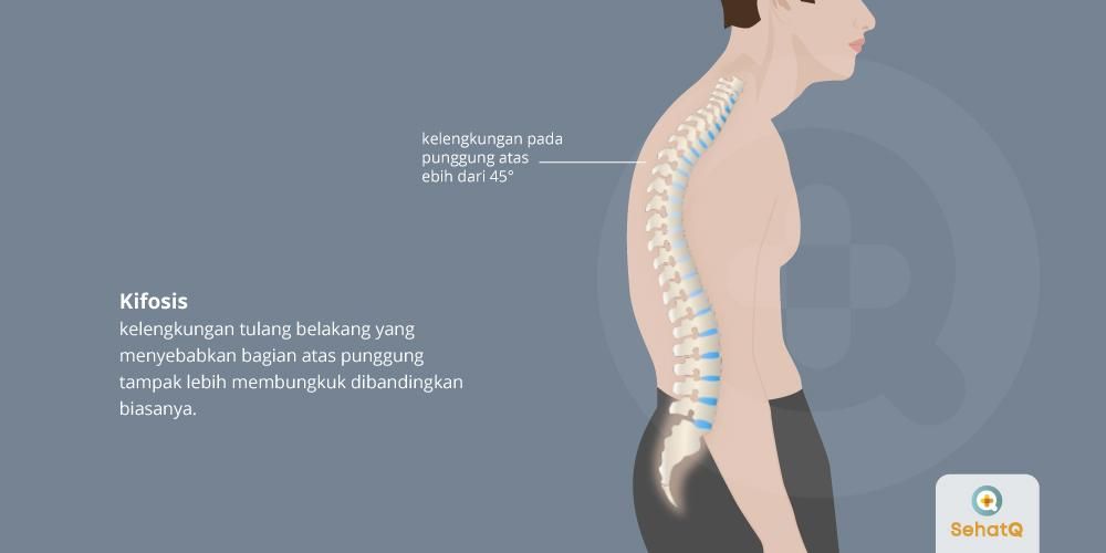 Detail Gambar Skoliosis Lordosis Dan Kifosis Nomer 55