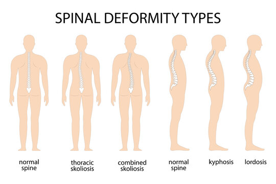 Detail Gambar Skoliosis Lordosis Dan Kifosis Nomer 57