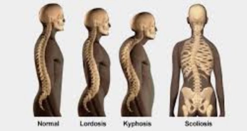 Detail Gambar Skoliosis Lordosis Dan Kifosis Nomer 7