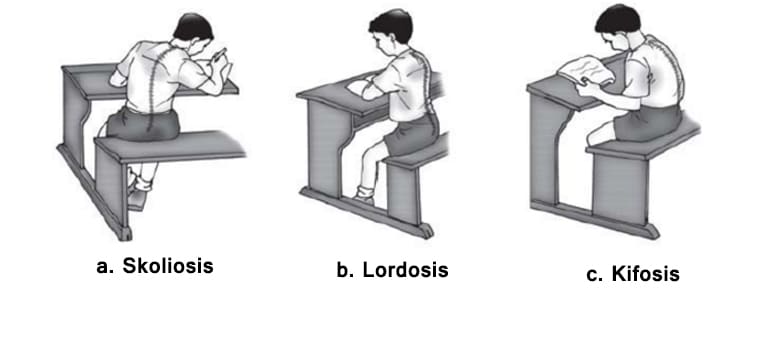 Detail Gambar Skoliosis Lordosis Dan Kifosis Nomer 8