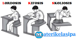 Detail Gambar Skoliosis Lordosis Dan Kifosis Nomer 9