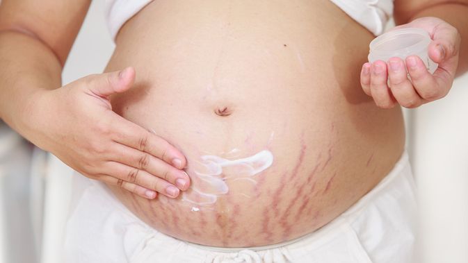 Gambar Stretch Mark Ibu Hamil - KibrisPDR