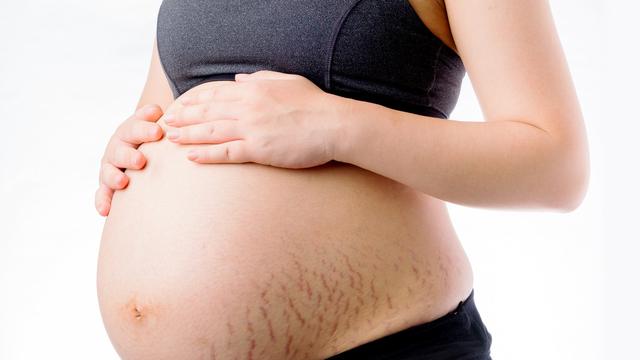 Detail Gambar Stretch Mark Ibu Hamil Nomer 2