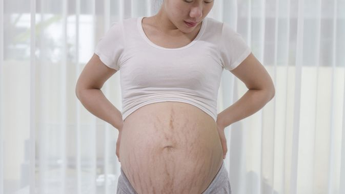 Detail Gambar Stretch Mark Ibu Hamil Nomer 3