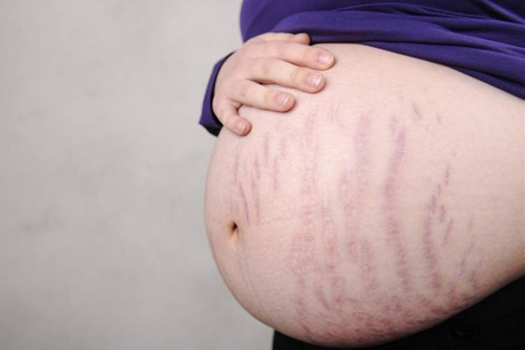 Detail Gambar Stretch Mark Ibu Hamil Nomer 21