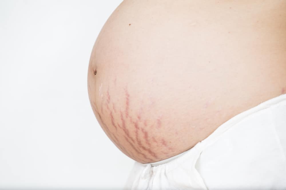 Detail Gambar Stretch Mark Ibu Hamil Nomer 22