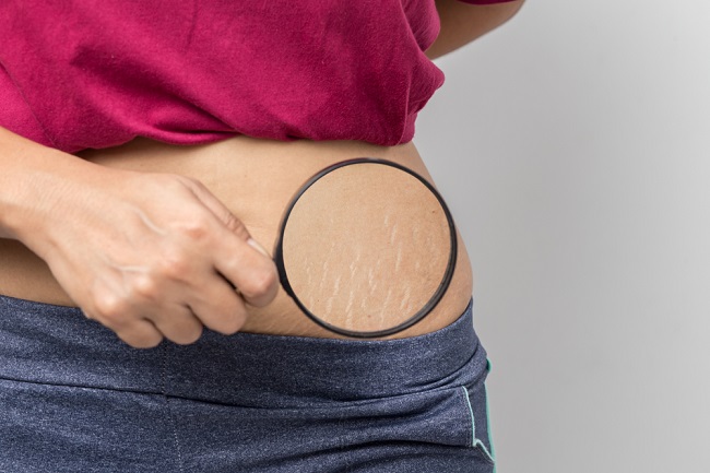 Detail Gambar Stretch Mark Ibu Hamil Nomer 28