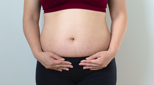 Detail Gambar Stretch Mark Ibu Hamil Nomer 38