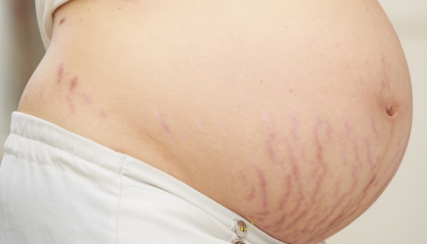 Detail Gambar Stretch Mark Ibu Hamil Nomer 5