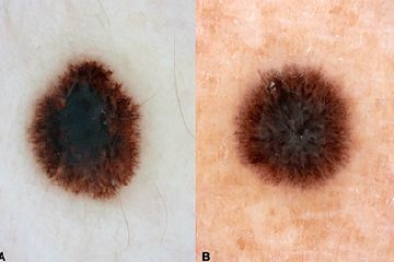 Detail Gambar Tahi Lalat Melanoma Nomer 13