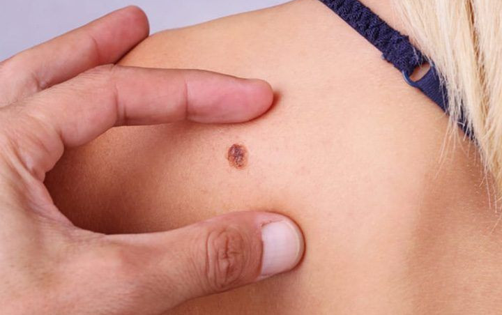 Detail Gambar Tahi Lalat Melanoma Nomer 29