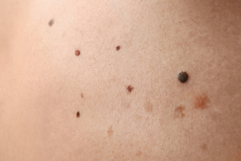 Detail Gambar Tahi Lalat Melanoma Nomer 9