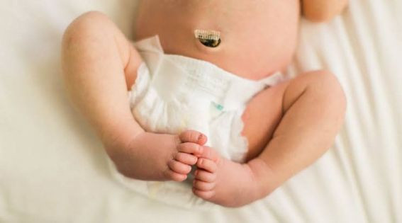 Detail Gambar Tali Pusar Bayi Infeksi Nomer 14
