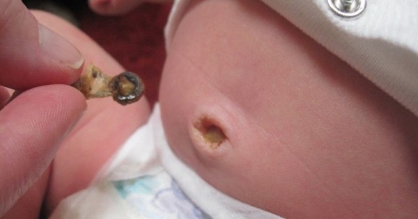 Detail Gambar Tali Pusar Bayi Infeksi Nomer 16