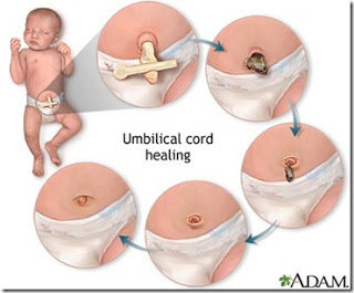 Detail Gambar Tali Pusar Bayi Infeksi Nomer 17