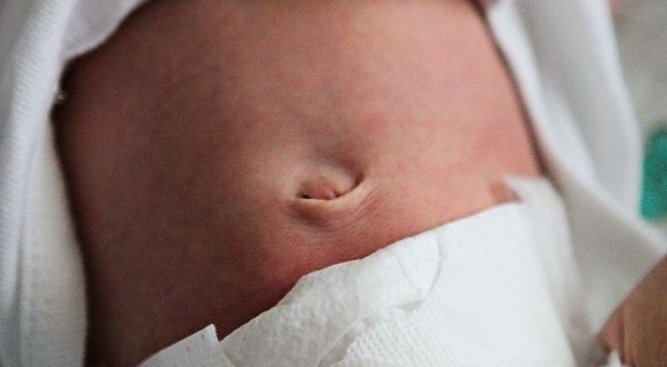 Detail Gambar Tali Pusar Bayi Infeksi Nomer 18