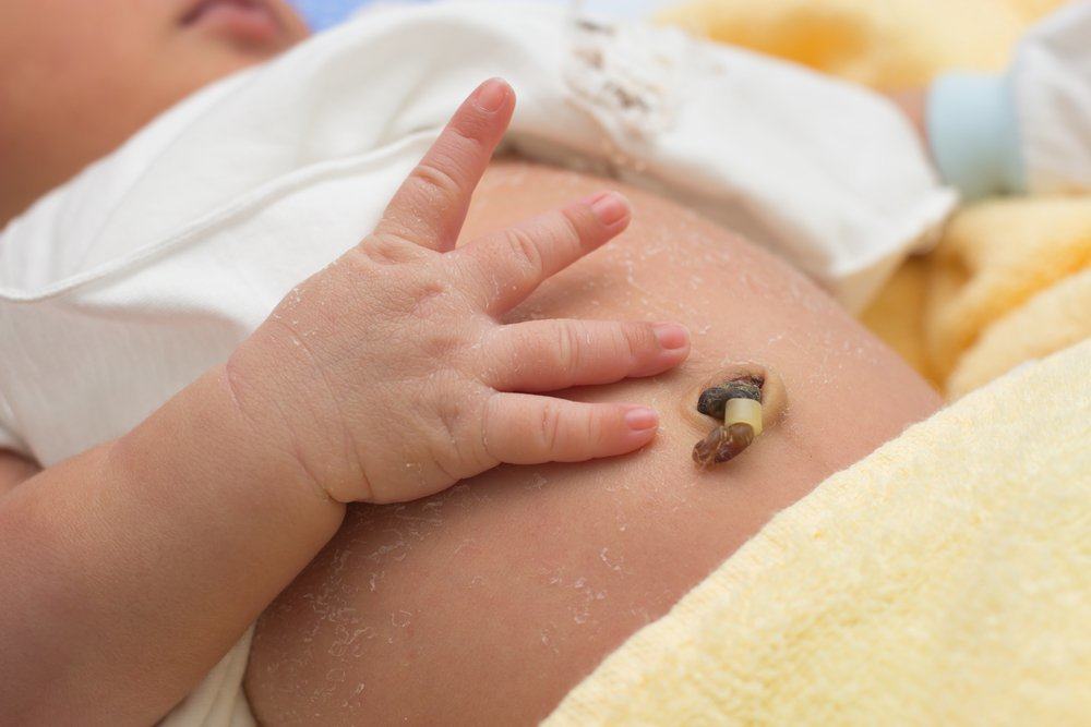 Detail Gambar Tali Pusar Bayi Infeksi Nomer 10