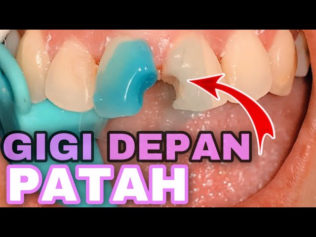 Detail Gambar Tambal Gigi Nomer 38