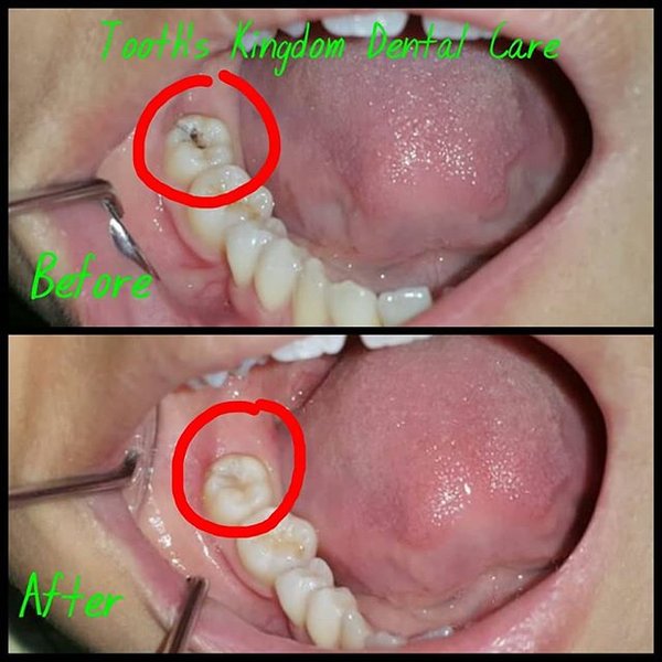 Detail Gambar Tambal Gigi Nomer 6