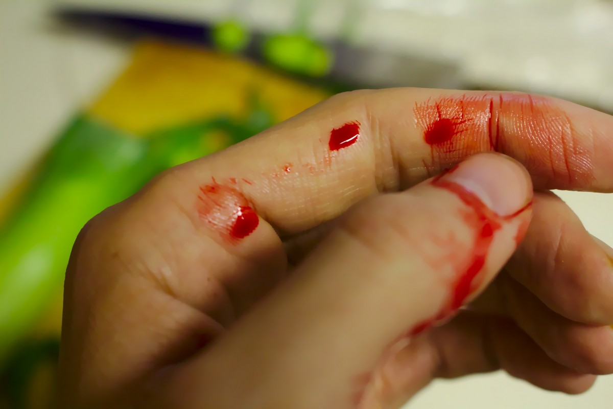 Detail Gambar Tangan Terluka Berdarah Nomer 2