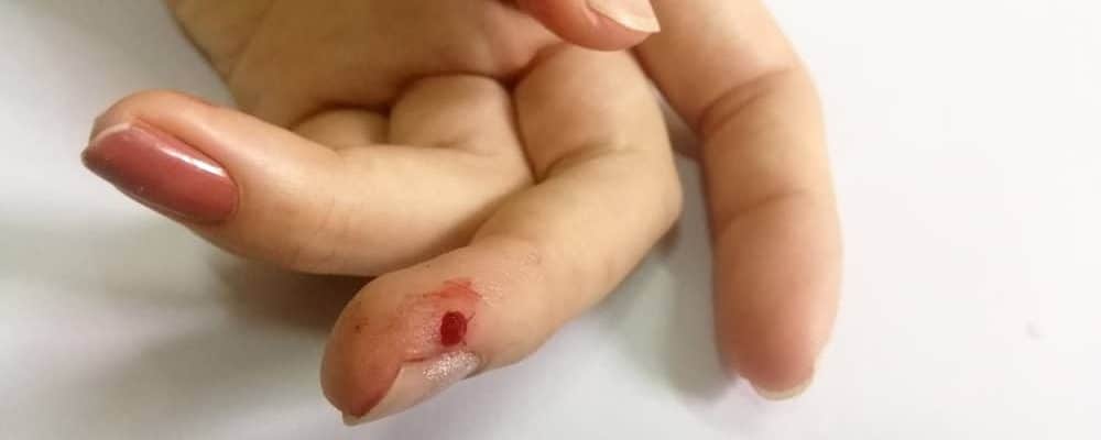 Detail Gambar Tangan Terluka Berdarah Nomer 48