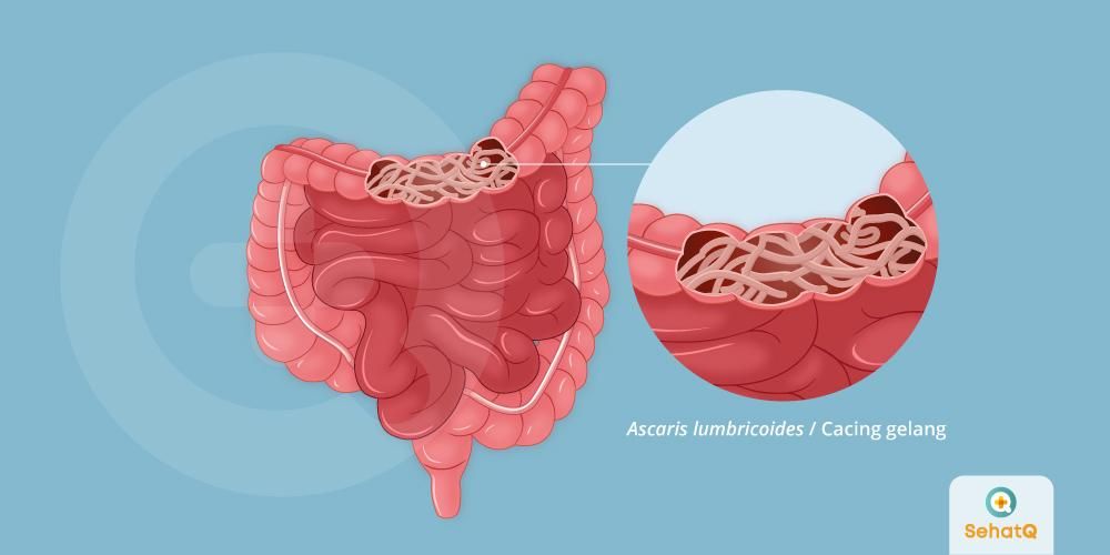 Detail Gambar Telur Ascaris Lumbricoides Nomer 45