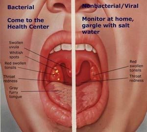 Detail Gambar Tenggorokan Sehat Nomer 9