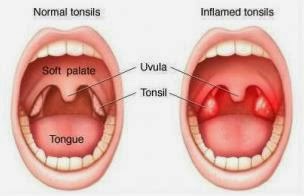 Detail Gambar Tenggorokan Sehat Nomer 25