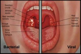 Detail Gambar Tenggorokan Sehat Nomer 6