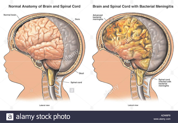 Detail Gambar Tentang Meningitis Pada Anak Nomer 13