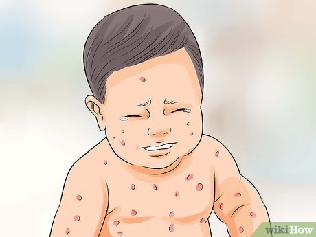 Detail Gambar Tentang Meningitis Pada Anak Nomer 55