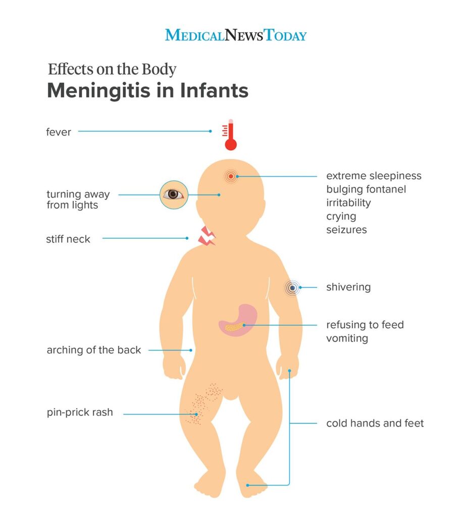 Detail Gambar Tentang Meningitis Pada Anak Nomer 9