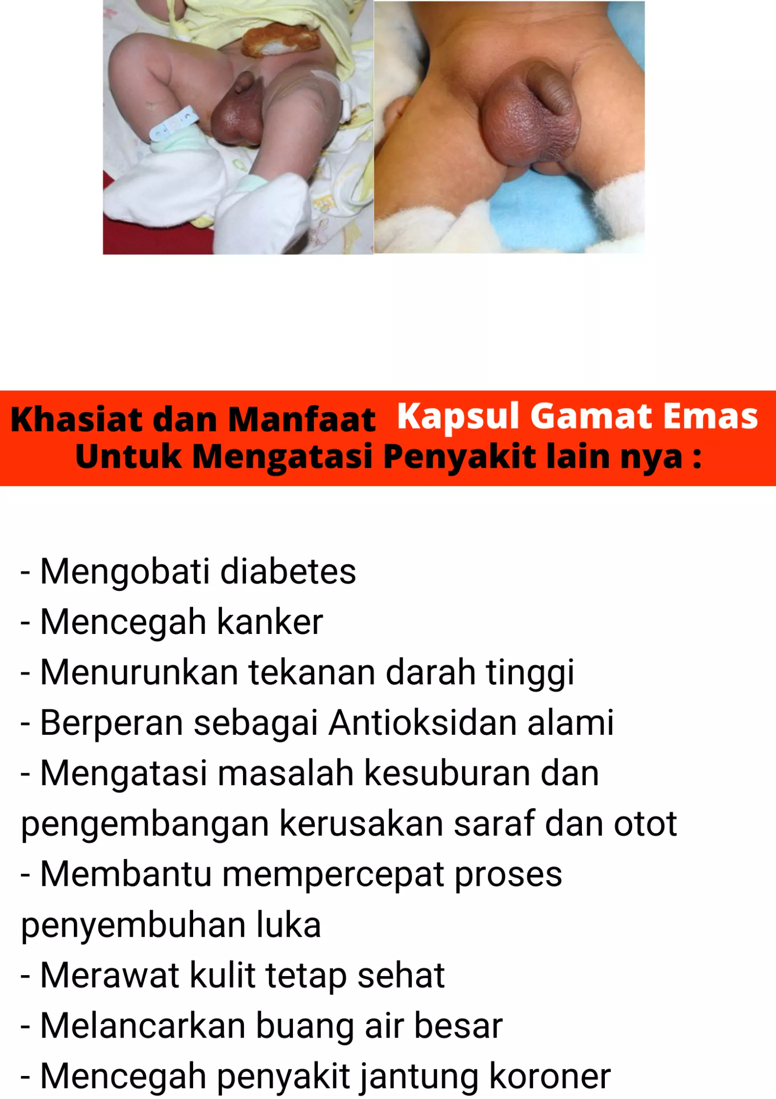 Detail Gambar Testis Bayi Belum Turun Nomer 12