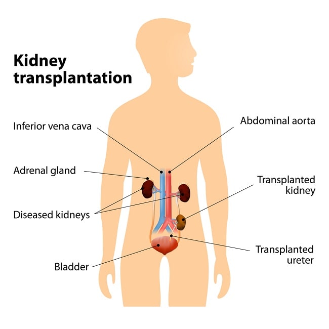 Detail Gambar Transplantasi Ginjal Nomer 2