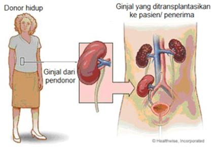 Detail Gambar Transplantasi Ginjal Nomer 22