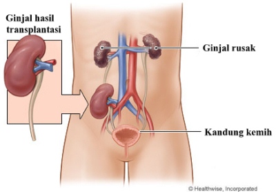 Detail Gambar Transplantasi Ginjal Nomer 3