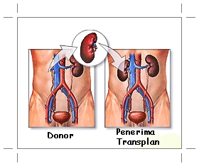 Detail Gambar Transplantasi Ginjal Nomer 4