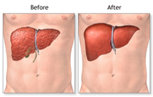 Detail Gambar Transplantasi Hati Nomer 2