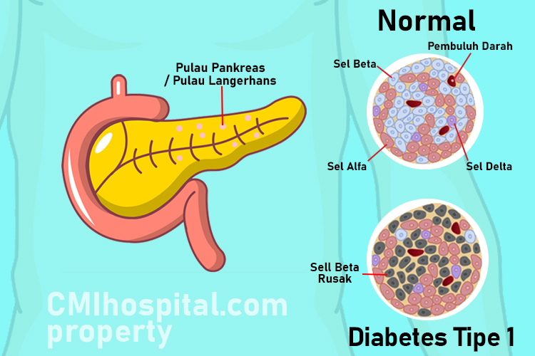 Detail Gambar Transplantasi Pankreas Nomer 18